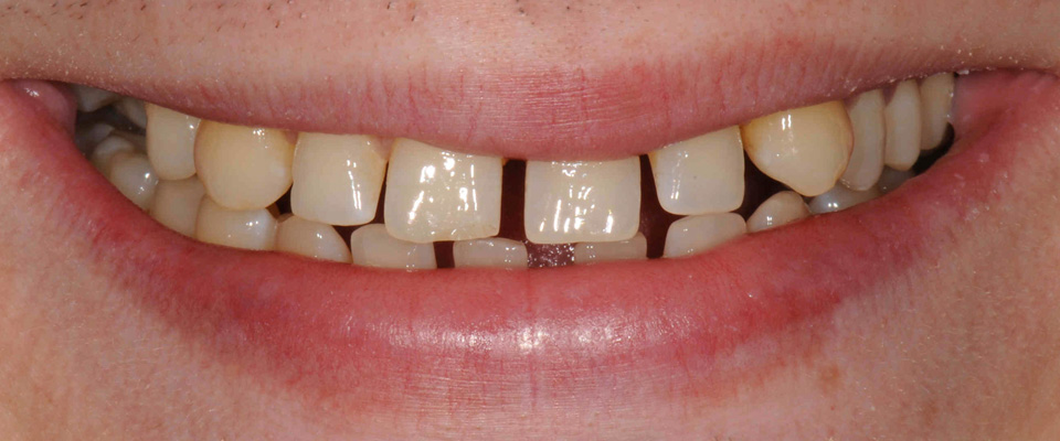 teeth veneers swindon