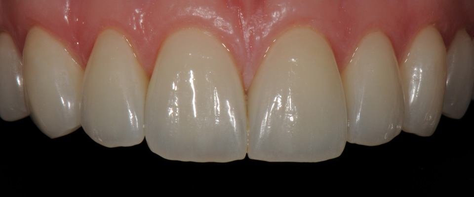 Veneer Case Three